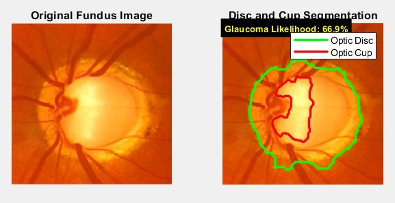 Fundus image 1 with disc and cup outlined